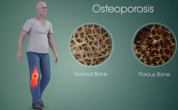 Найден новый способ лечения остеопороза