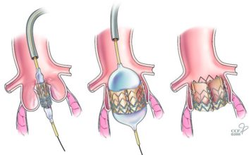 Доказана высокая эффективность хирургической сердечной системы TAVR
