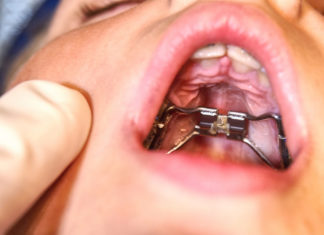Нёбные экспандеры – что это и для чего это нужно?