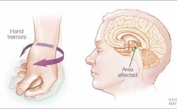 Создано устройство для ранней диагностики синдрома Паркинсона