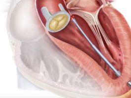 Создан уникальный робот-катетер для операций на сердце