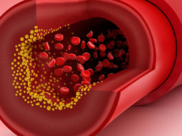Холестерин не является причиной номер один сердечных приступов