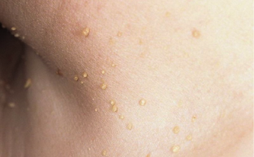 Лазерное удаление папиллом в Набережных Челнах