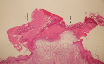 Недостаток сна может вызывать серьезные воспаления тканей