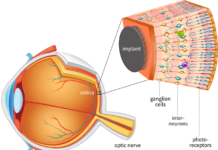 Ученые из Оксфорда улучшили технологию искусственной сетчатки