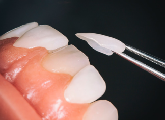 Основные преимущества виниров