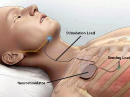 Найден уникальный способ устранить апноэ во сне
