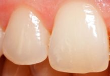 Представлен способ создания материала, копирующего свойства костей и эмали