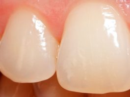 Представлен способ создания материала, копирующего свойства костей и эмали