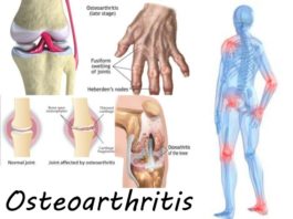 Ученые предлагают бороться с остеоартритом по-новому