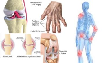 Ученые предлагают бороться с остеоартритом по-новому