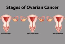 Создан особый ИИ для диагностики рака яичников
