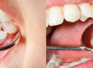 Цены на пломбирование зубов в Киеве