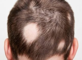 Ранняя алопеция у мужчин: причины и способы лечения