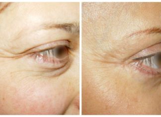 Отличная блефаропластика в Киеве для вас!