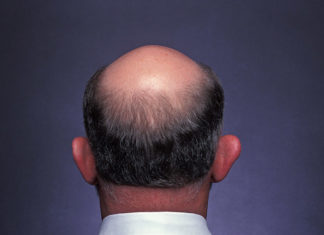 Как избавиться от лысины?