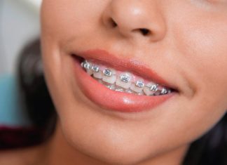 Цены на детские брекеты в Украине