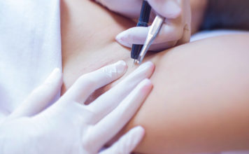 Лазерная эпиляция в Измаиле