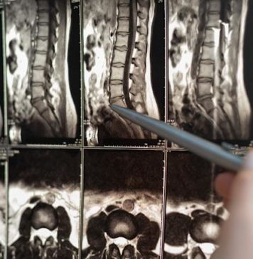 Искусственный интеллект способен помочь в восстановлении спинного мозга