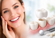 Коронки на зуби: що це таке та коли вони необхідні